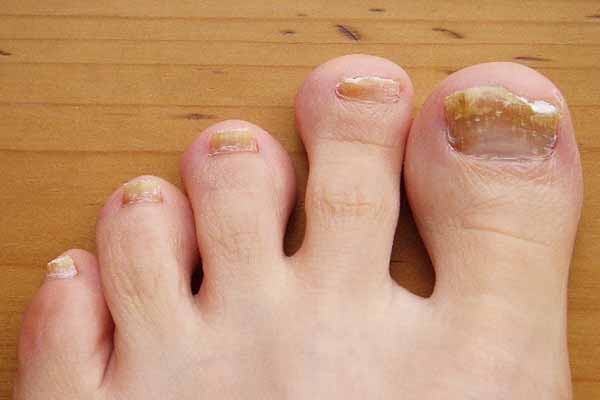 Почему ногти на ногах желтые: грибок