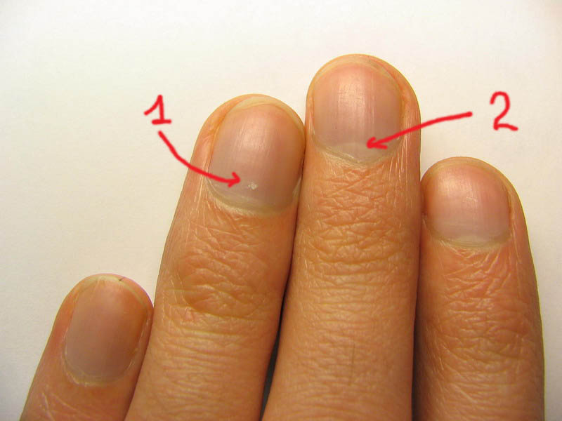 Почему на ногтях появляются белые пятна