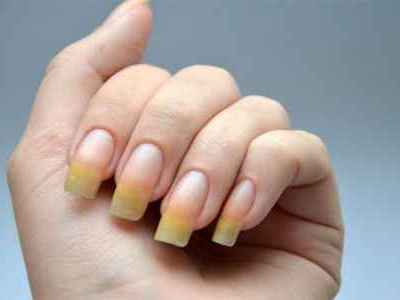 Почему желтеют ногти на руках у женщин