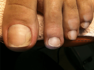 Зачастую грибок путают с возрастным изменением ногтей