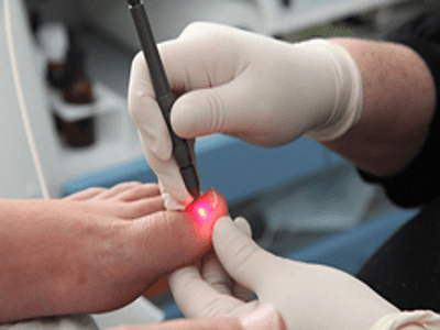 Лазер – самый безболезненный способ лечения грибка на ногтях