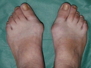 Болезнь косточки большого пальца ноги