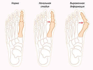 Стадии формирования косточки на ноге