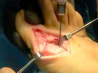 Операция на косточке большого пальца ноги