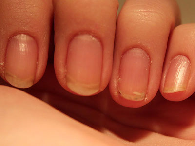 Как выглядят расслоившиеся и ломкие ногти