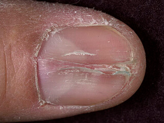 Серединная каналообразная дистрофия ногтя большого пальца