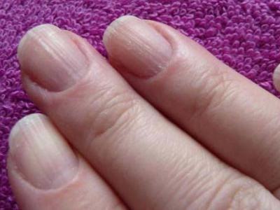 Почему ногти становятся ребристыми: продольные борозды из-за травмы