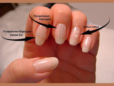Какие бывают изменения ногтевой пластины на руках