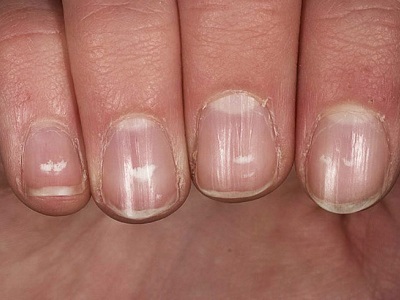 Причины возникновения борозд на ногтях