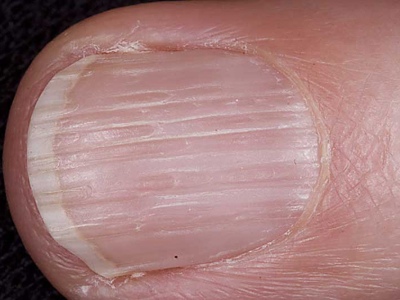Что такое борозды на ногтях