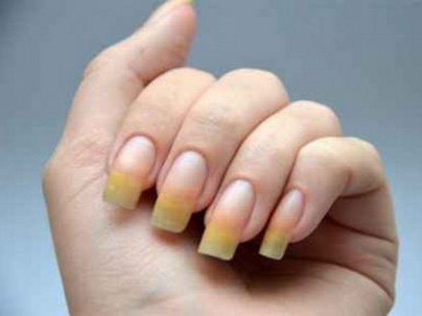 Изменение цвета ногтя - один из признаков ониходистрофии