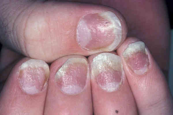 Ониходистрофия ногтей на руках: симптомы