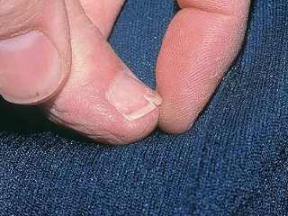 Расслоенные ногти выглядят неаккуратно