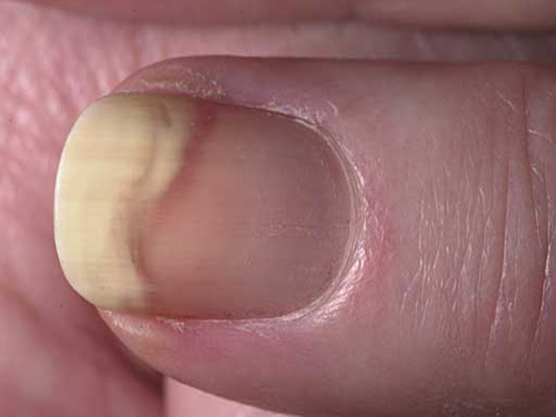 Отслоение ногтя от ногтевого ложа на руке