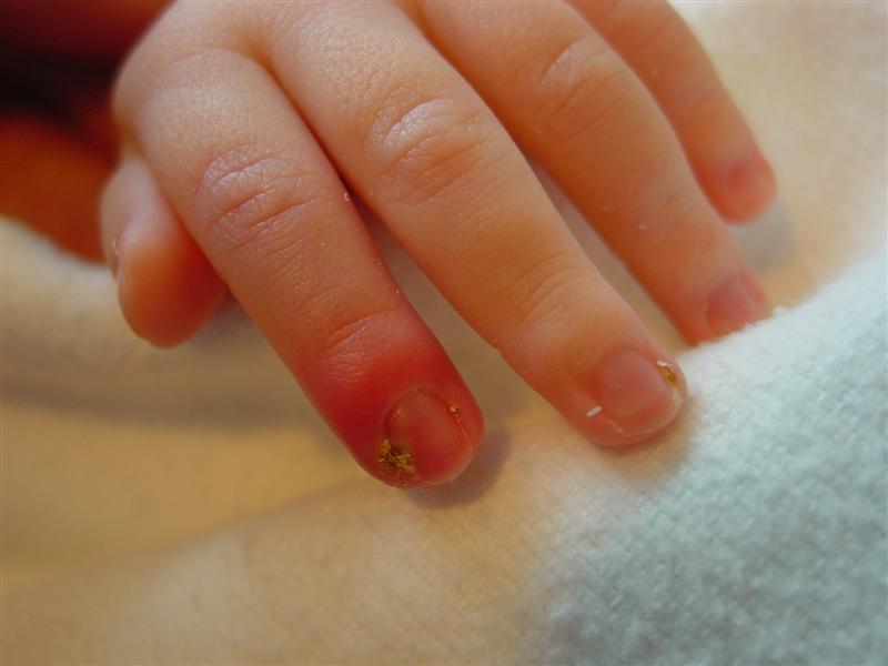 Причины панариция у детей – заусеницы и врощенные ногти