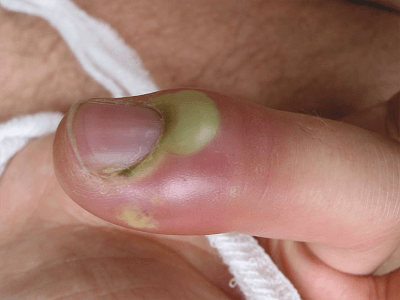 Нарыв на пальце возле ногтя: лечение