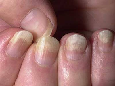 Псориаз ногтей пальцев рук