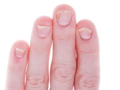 Симптомы псориаза ногтей рук
