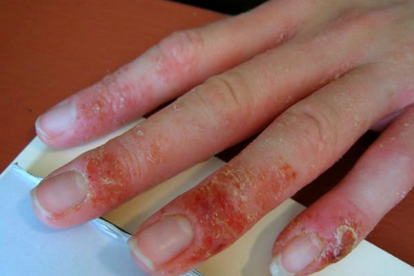 Аллергия на гель-лак чем лечить