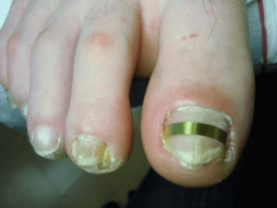 Пластины для вросших ногтей схожи с брекетами в стоматологии