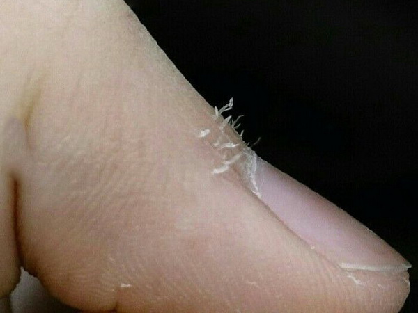 Заусенцы - разрывы кожи ногтевого валика