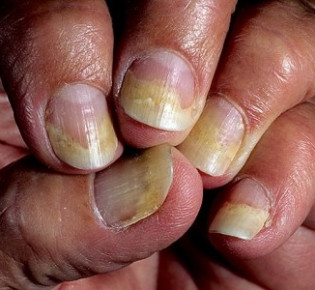 Как лечить псориаз ногтей традиционным способом на разных стадиях заболевания
