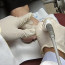 Лазерное лечение грибка ногтей: преимущества метода