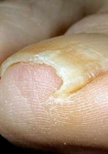 Лечение грибка ногтей на ногах народными средствами: как распознать онихомикоз