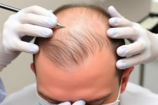 Пересадка волос: что реально нужно знать, чтобы не пожалеть