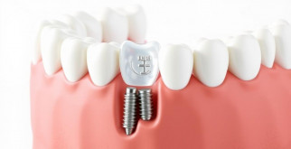 Имплантация зубов: возвращаем улыбку на лицо