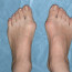 Вальгусная деформация большого пальца стопы: причины и клиническая картина