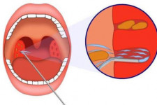 Хронический тонзиллит: причины, опасности и лечение