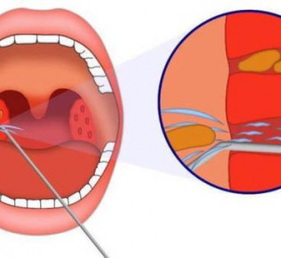 Хронический тонзиллит: причины, опасности и лечение