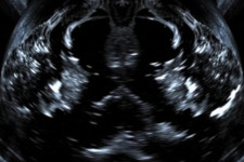 УЗИ лимфатических узлов: что показывает, как проводят и когда бежать к врачу