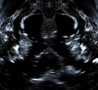 УЗИ лимфатических узлов: что показывает, как проводят и когда бежать к врачу