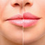 Контурная пластика губ: идеальное решение для создания соблазнительной улыбки