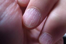 Ногти слоятся и ломаются: причины данного недуга