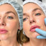 Филлеры для лица: что это, как работают и как выбрать своё безопасно