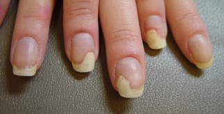 Лечение онихолизиса ногтей медикаментозными средствами