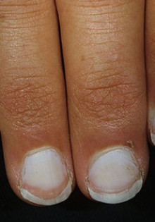 Лечение кандидоза ногтей, его причины и симптомы