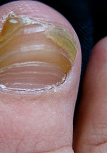 Как лечить грибок ногтей на ногах и каковы причины его появления