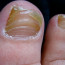 Как лечить грибок ногтей на ногах и каковы причины его появления