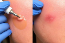 Для кого подходит удаление бородавок азотной кислотой