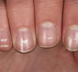 Борозды на ногтях: что это такое
