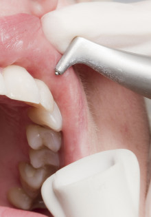 Как осуществляется удаление зуба под коронкой?