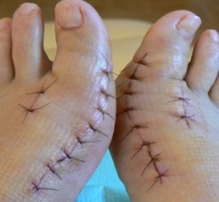 Удаление косточки на большом пальце ноги: операция как метод консервативного лечения