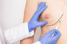 Гинекомастия у мужчин: как проходит лечение