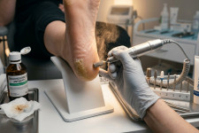 Аппаратный педикюр при трещинах и гиперкератозе