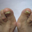 Утолщение ногтей на ногах: причины, диагностика