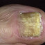 Микоз ногтей: признаки, симптомы и диагностика